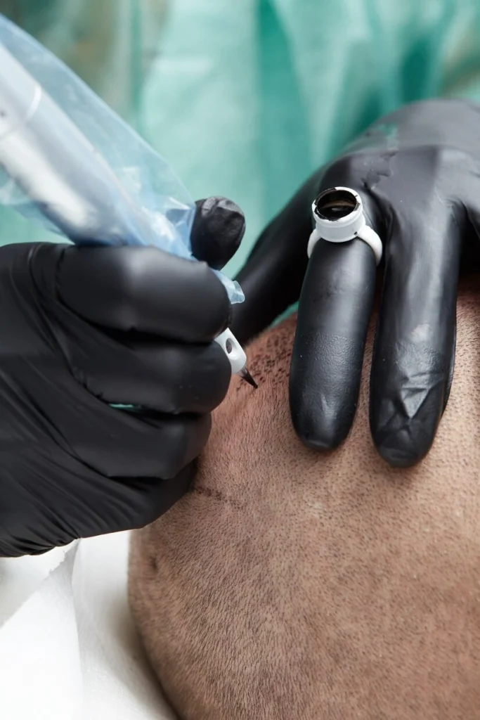 scalp tricopigmentation treatment
